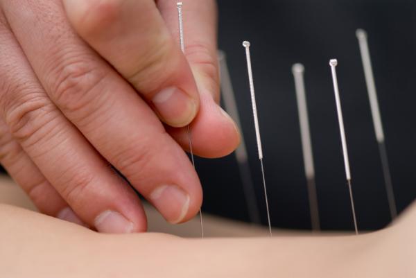 Acupuncture Needling Tereatment